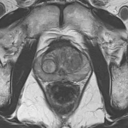 前立腺MRIの画像。骨盤の横断面
