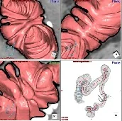 大腸CTの画像。大腸の内側と全体を立体的に表示した4つのコマ