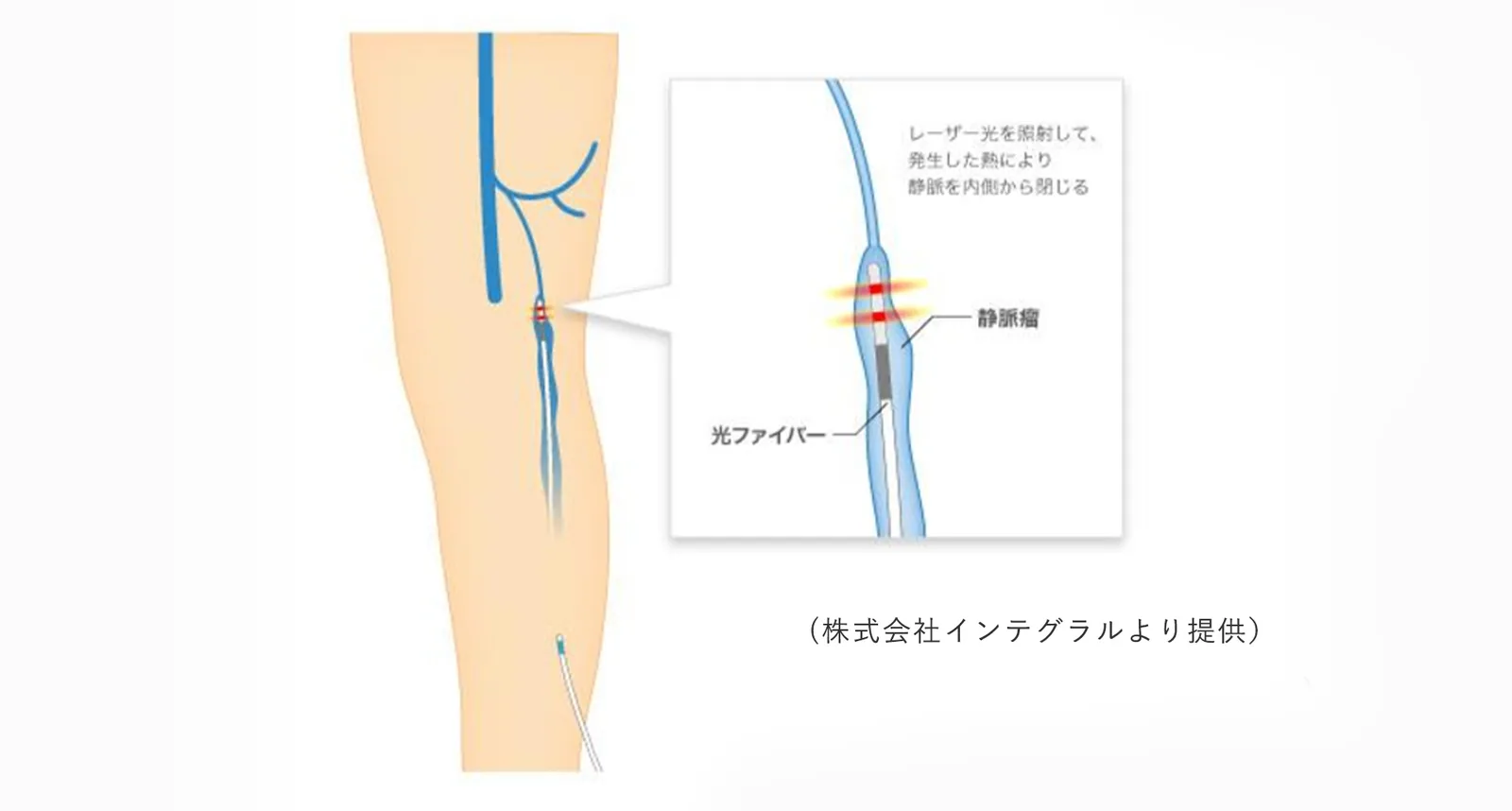 血管内レーザー治療の模式図。脚の静脈瘤の中に光ファイバーを入れ、レーザー光で発生した熱により静脈を内側から閉じる