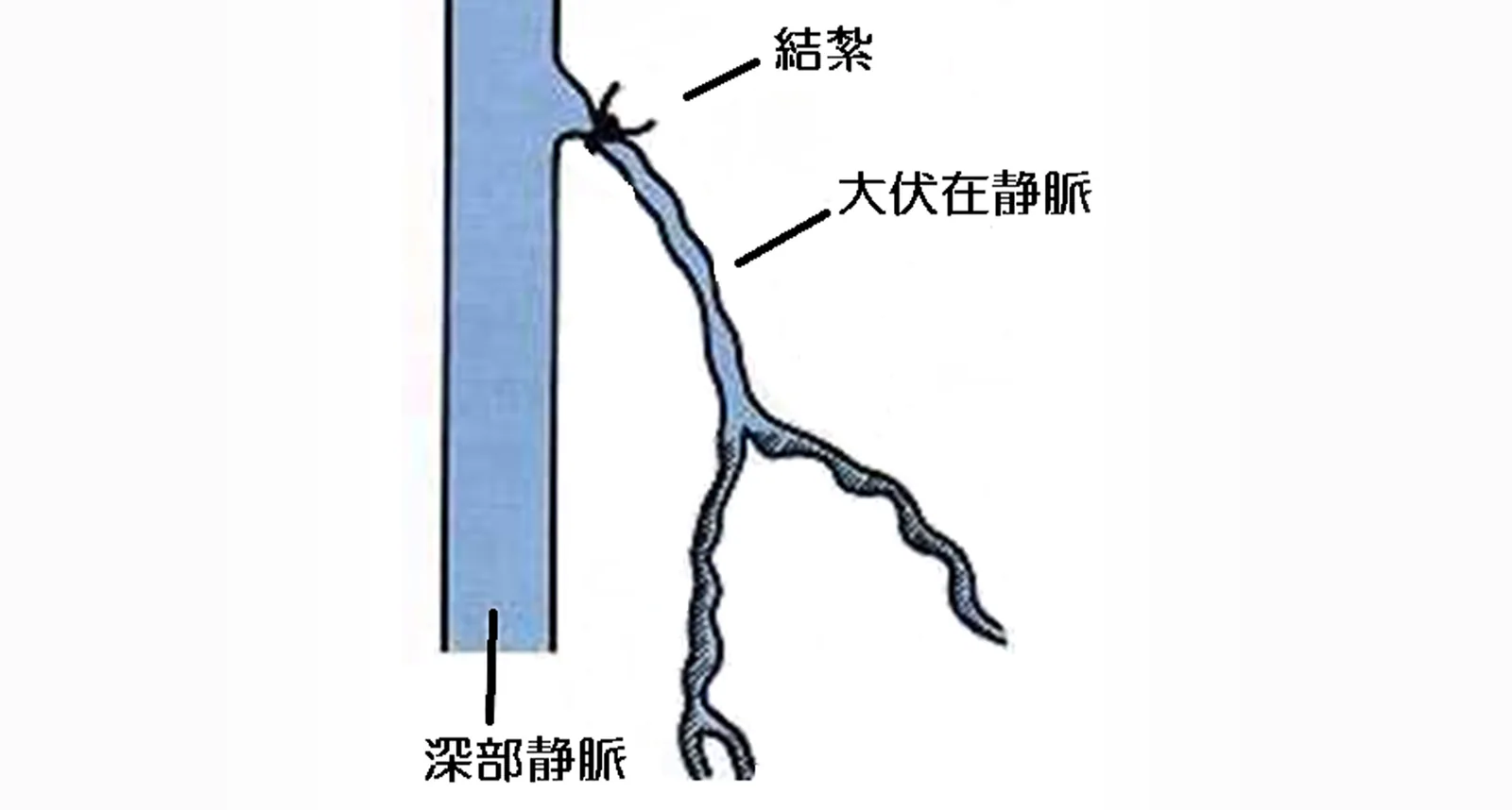 高位結紮術の模式図。深部静脈に合流する根元で、大伏在静脈を糸で結んでいる